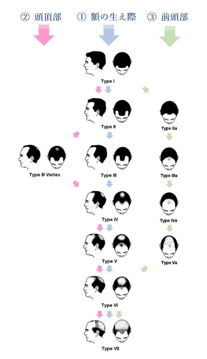 生え際でも発毛治療できますか？ガーデンクリニック発毛医療外来