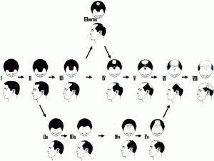 AGAは自分で診断することが可能？ この症状はAGAが進行し始めてる証拠かも