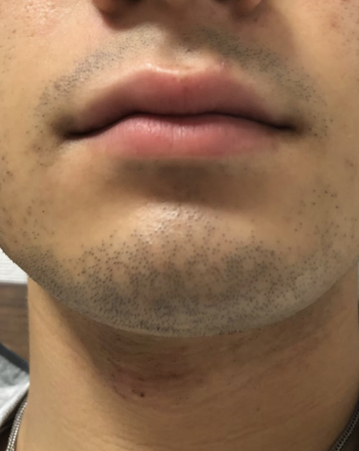 ヒゲ脱毛に行ってきたｗ MEN's TBCcRomBiyori