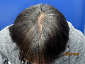 ハミルトン・ノーウッド分類 ハゲ イラスト素材6286967- フォトライブラリー photolibrary