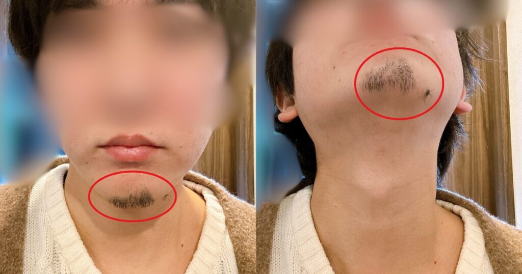 実体験 メンズTBCの500円 1000円 脱毛の口コミメンズ脱毛ブログ