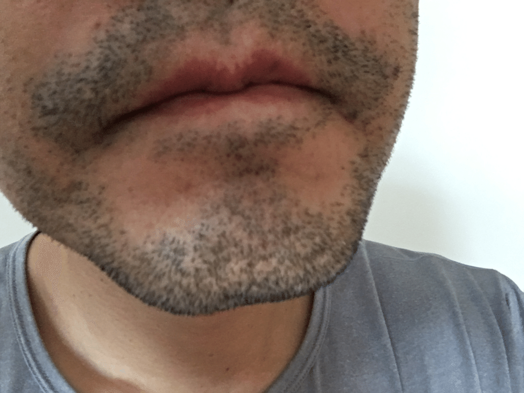 ヒゲ脱毛7回目の感想施術の痛みに電流走る っ！施術後のポップアップも長かった どろぼうヒゲしんしょライフ
