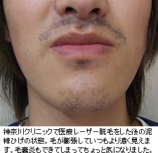 2回目 髭脱毛の効果と痛み 写真付き ひげの抜け具合や泥棒ヒゲが起きたか実体験から検証MOTEO