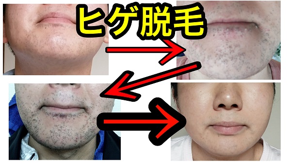 Before After— ☀️ひげ脱毛 2回終了☀️ 🚹30代男性 建設業 💭朝剃っても夕方に生えてくる 💭どろぼうさんみたいと言われてしまう💭ひげが濃くて髭剃りがしにくい との事で脱毛デビューをしました✨️ 2回のお手入れが終わり全体的に減りました😳 まだ2回ですが髭剃りも