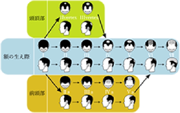うす毛の進行パターン - 渋谷ウエストクリニック 薄毛治療・勃起不全治療