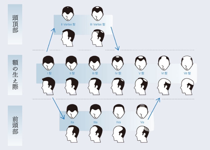 ハミルトン・ノーウッド分類とは！？AGAのタイプについて解説！駅前AGAクリニック 新宿、北千住、大阪、京都、岡山、鹿児島など