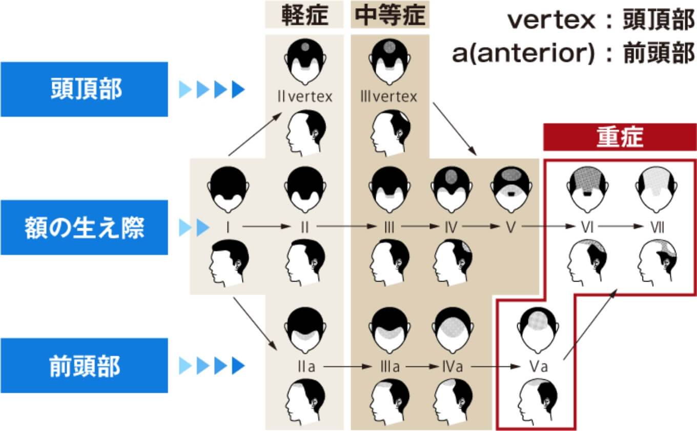研究会監修 HARG ハーグ 療法の特徴解説-薄毛 AGAの専門治療