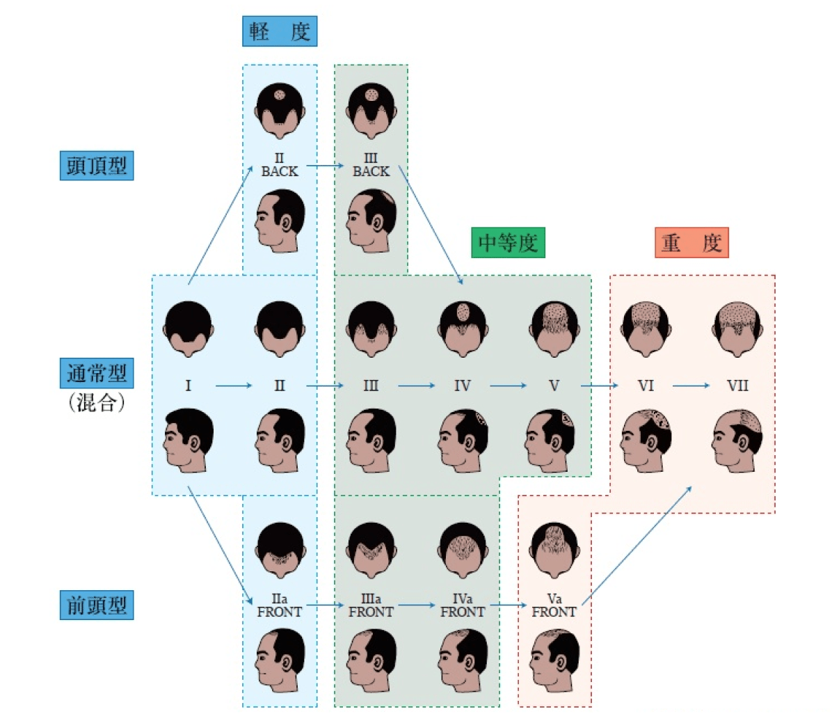 薄毛の進行度を知る、ハミルトン・ノーウッド分類とは - 薄毛・抜け毛対策に！視覚的に増毛が可能なスーパーミリオンヘアー SMH
