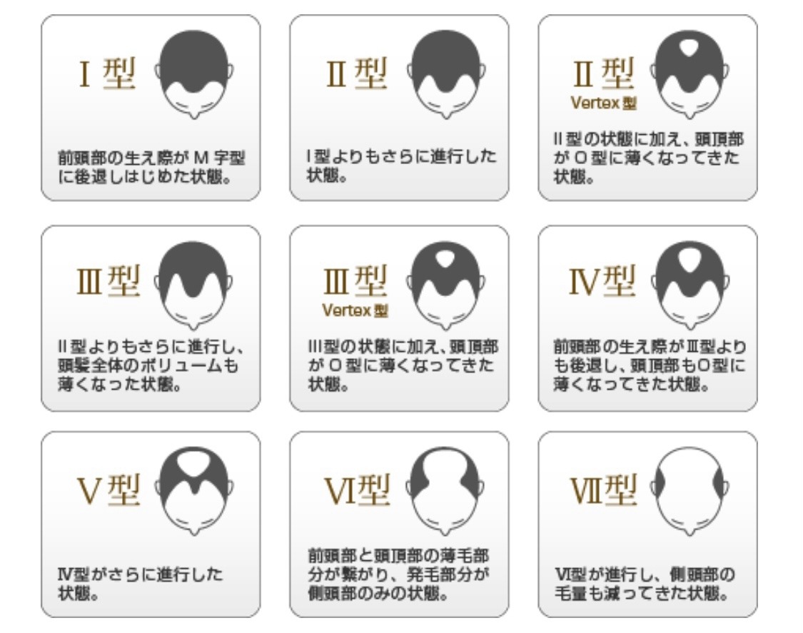 薬剤師監修 ハミルトンノーウッド分類でAGAの進行度をチェックしよう！薄毛対策ラボAGA管理アプリ HIX