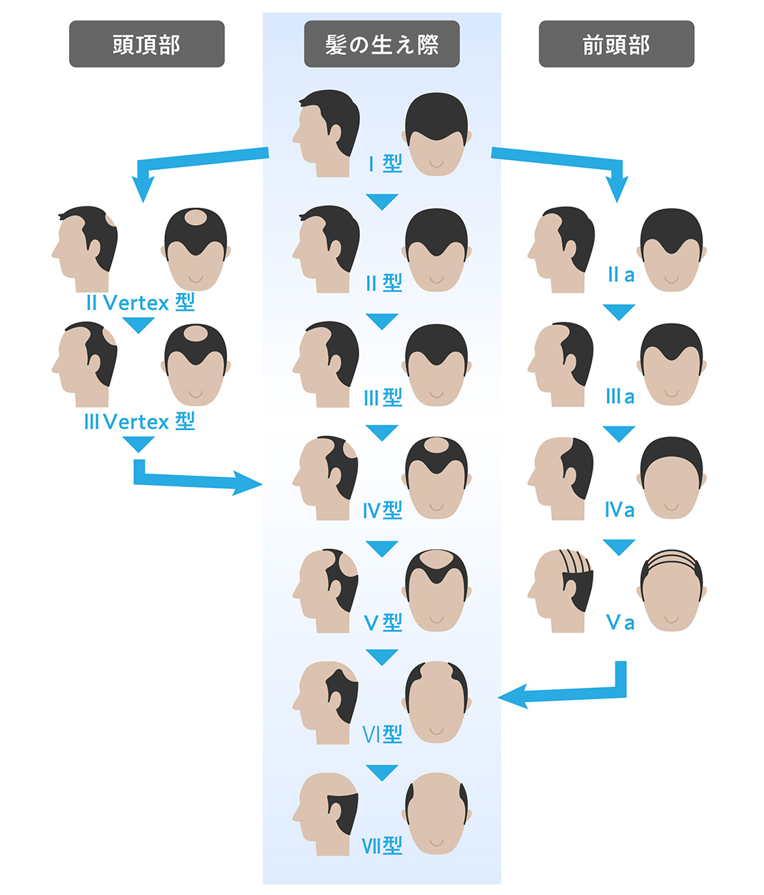 30代 男性 Ⅲ型 治療期間4か月全国100院以上 医師によるAGA治療 価格一律で安心 ドクターズヘア 公式