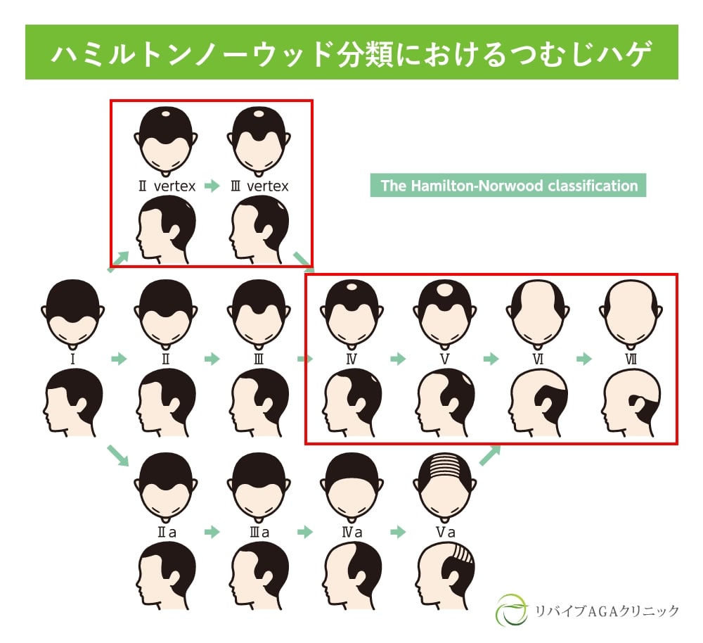 AGA 男性型脱毛症 についてアデランス