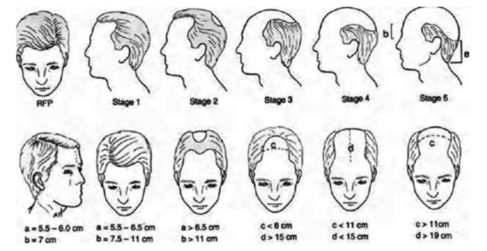 36歳男性 ハミルトン・ノーウッド分類でIII M字部分の拡大が主体の患者さんです スマートFUE植毛1,000グラフトとダブルマトリックス及び湘南オリジナルAGA治療薬の タブレット３種類とスプレーで治療しました 生え際に関しては植毛の効果が顕著であることが 改めてご理解