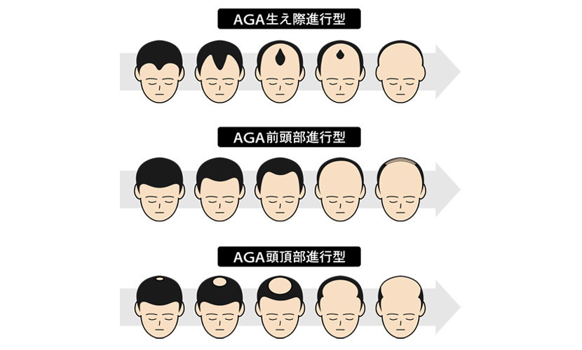 あなたの薄毛のタイプはO型？M型？AGAのタイプ別進行パターン - 薄毛・AGA治療なら はなふさ皮膚科