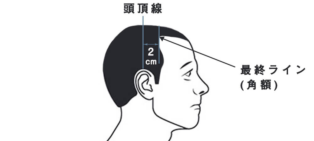 うす毛の分類 – ヘア&スキンクリニック福岡院