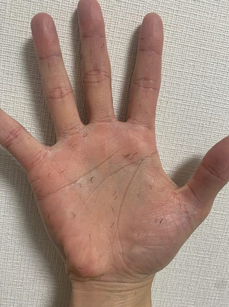 髭脱毛でどろぼうひげ発生！いつまで続くの？対策は？期間や原因を徹底解明まるわかりメンズ脱毛