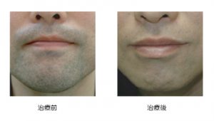 ヒゲ脱毛後の泥棒ヒゲの期間は約1週間解決方法を徹底解説 - ゴリラの医療脱毛コラム