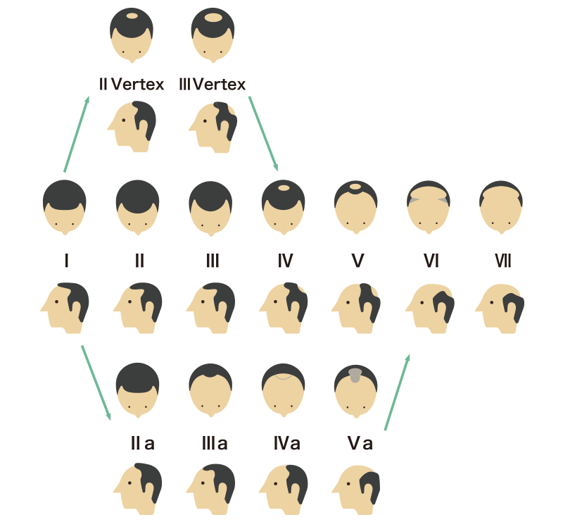 ハミルトン・ノーウッド分類とは！？AGAのタイプについて解説！駅前AGAクリニック 新宿、北千住、大阪、京都、岡山、鹿児島など