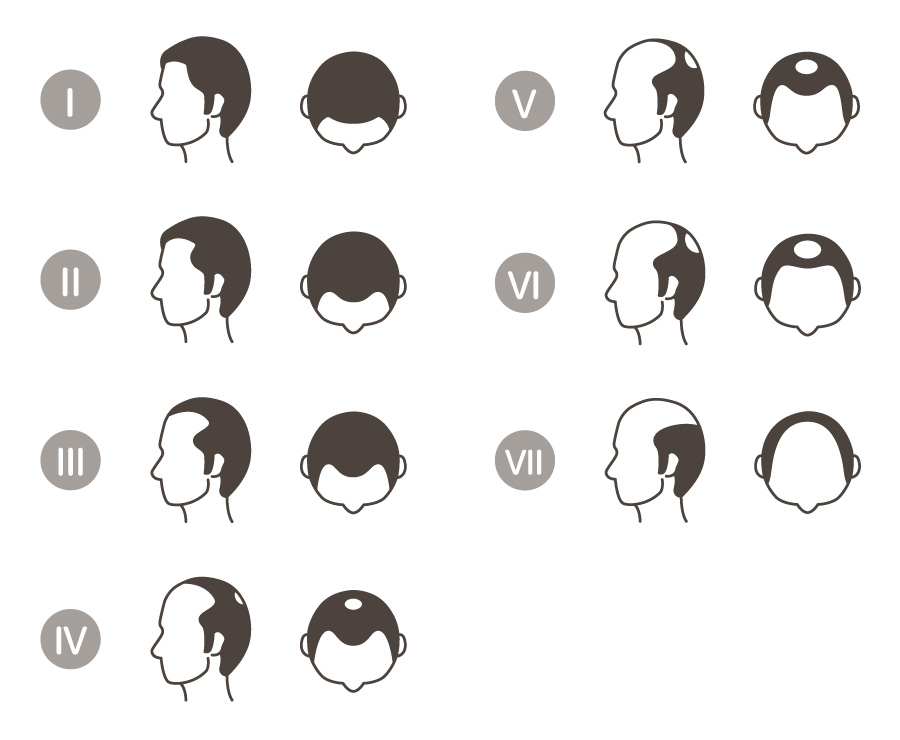 抜け毛・薄毛治療と改善潮来市・神栖市・鹿島市 幸せ鍼灸 まさと院