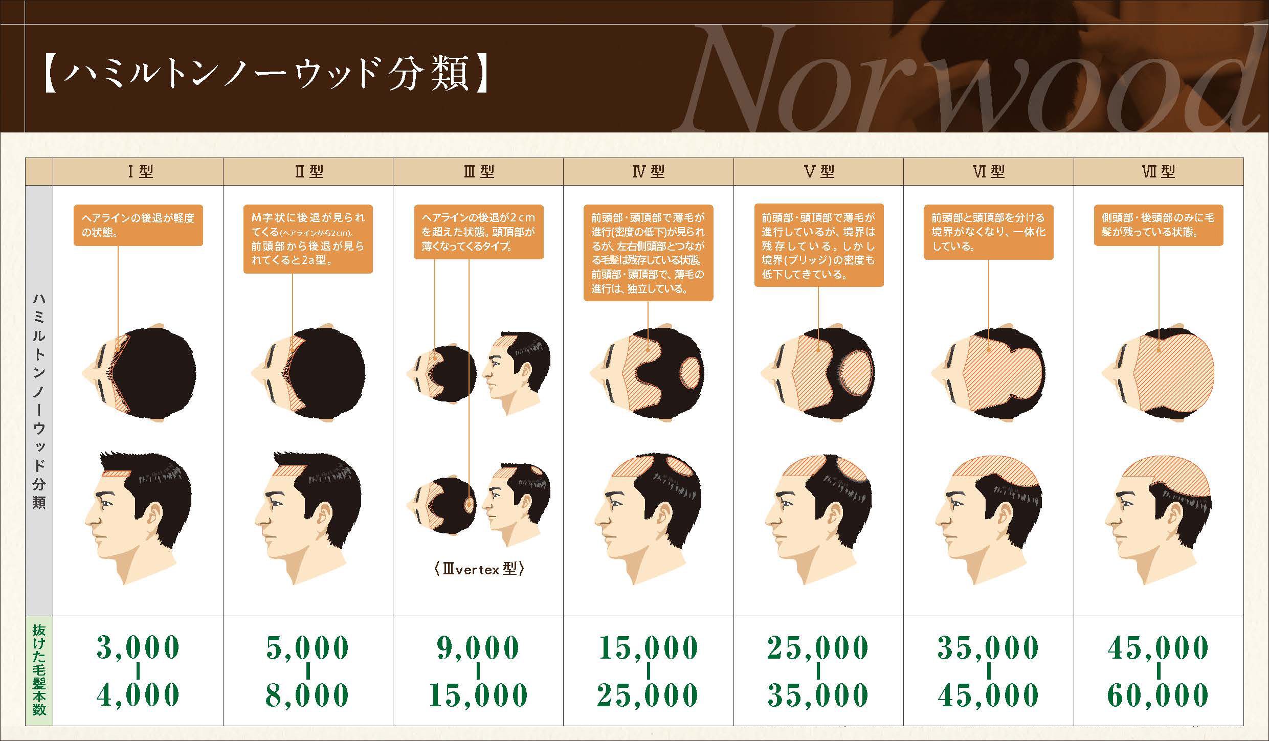 AGA進行度 ハミルトンノーウッド分類 別症例写真湘南AGAクリニックの薄毛治療・自毛植毛